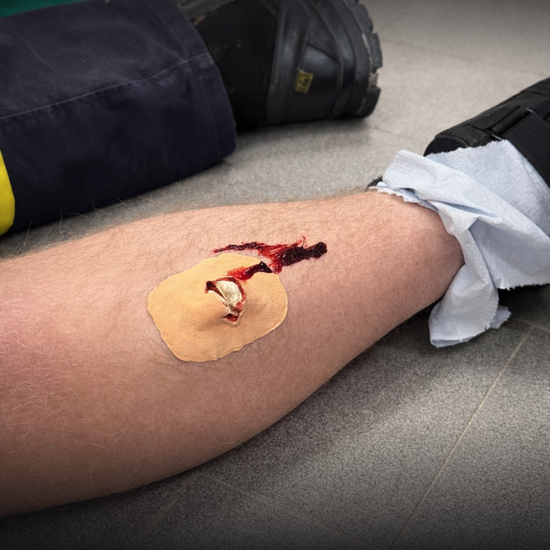 Eine Verletzung an einem Bein